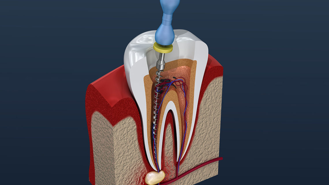 Root Canal Treatment