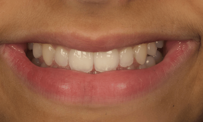 Smile Gallery