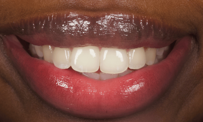 Smile Gallery