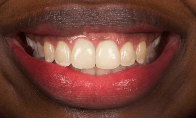 Smile Gallery